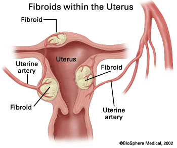 image of a uterus with fibroids